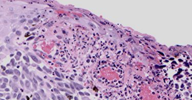 Molecular targeted therapies in metastatic melanoma